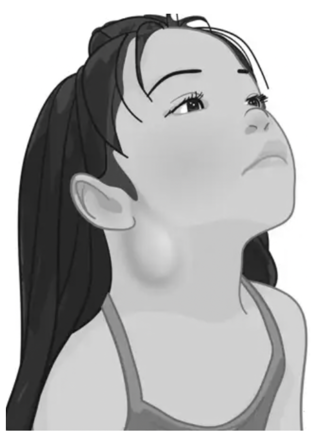 Congenital Neck Masses